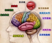 宫颈糜烂的治疗
